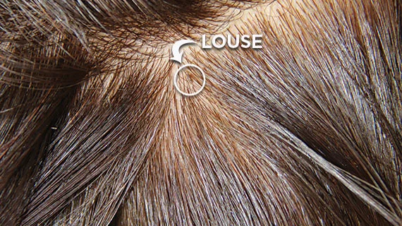Head louse in the hair