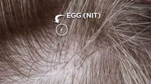 Lice egg on hair shaft