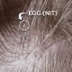 Lice egg on hair shaft