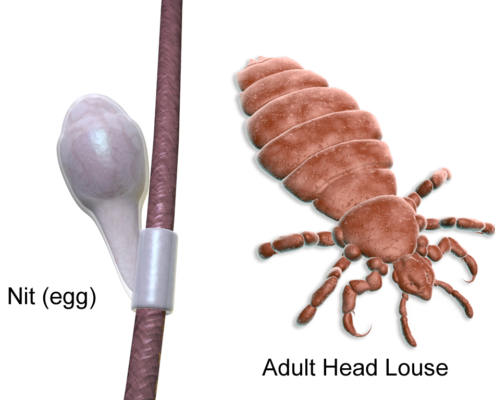 Nit Egg and adult head louse
